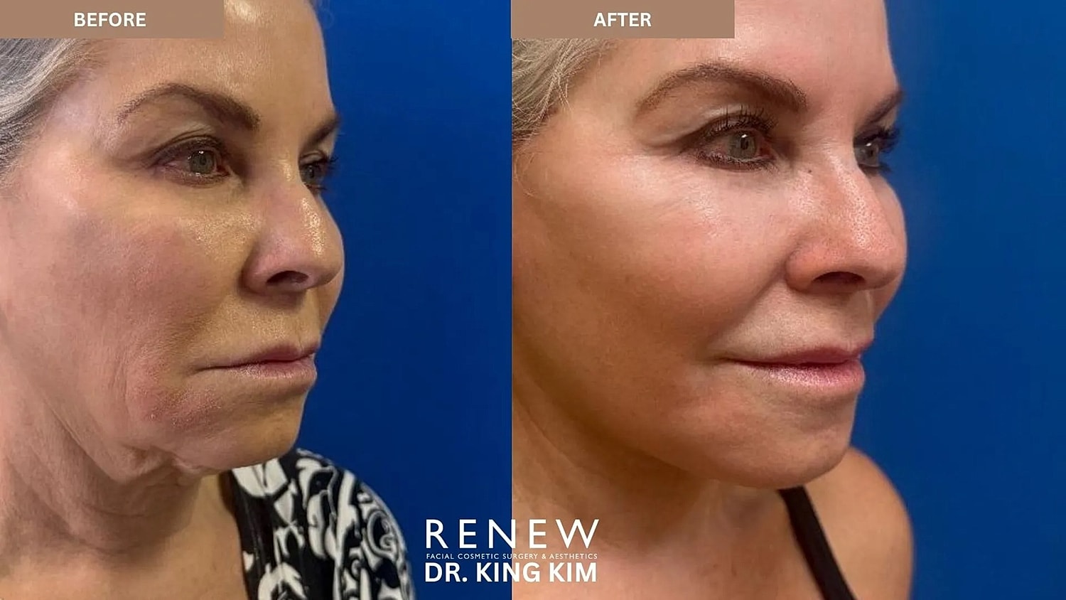 Cosmetic procedure before and after comparison.