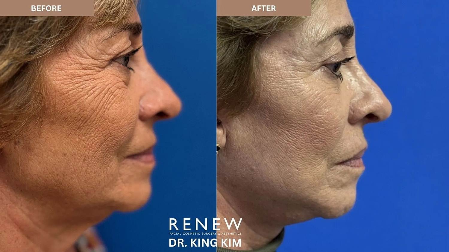 Before and after facial rejuvenation treatment comparison.
