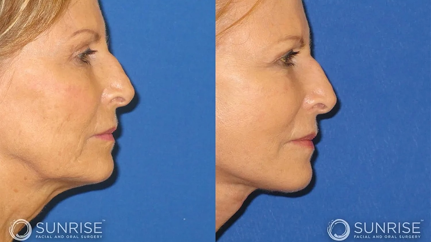 Before and after facial profile comparison.