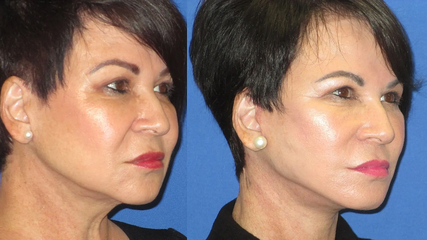 Before and after cosmetic treatment comparison.