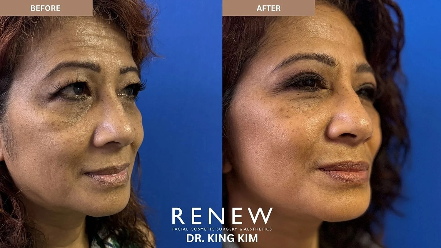 Before and after facial cosmetic procedure comparison.