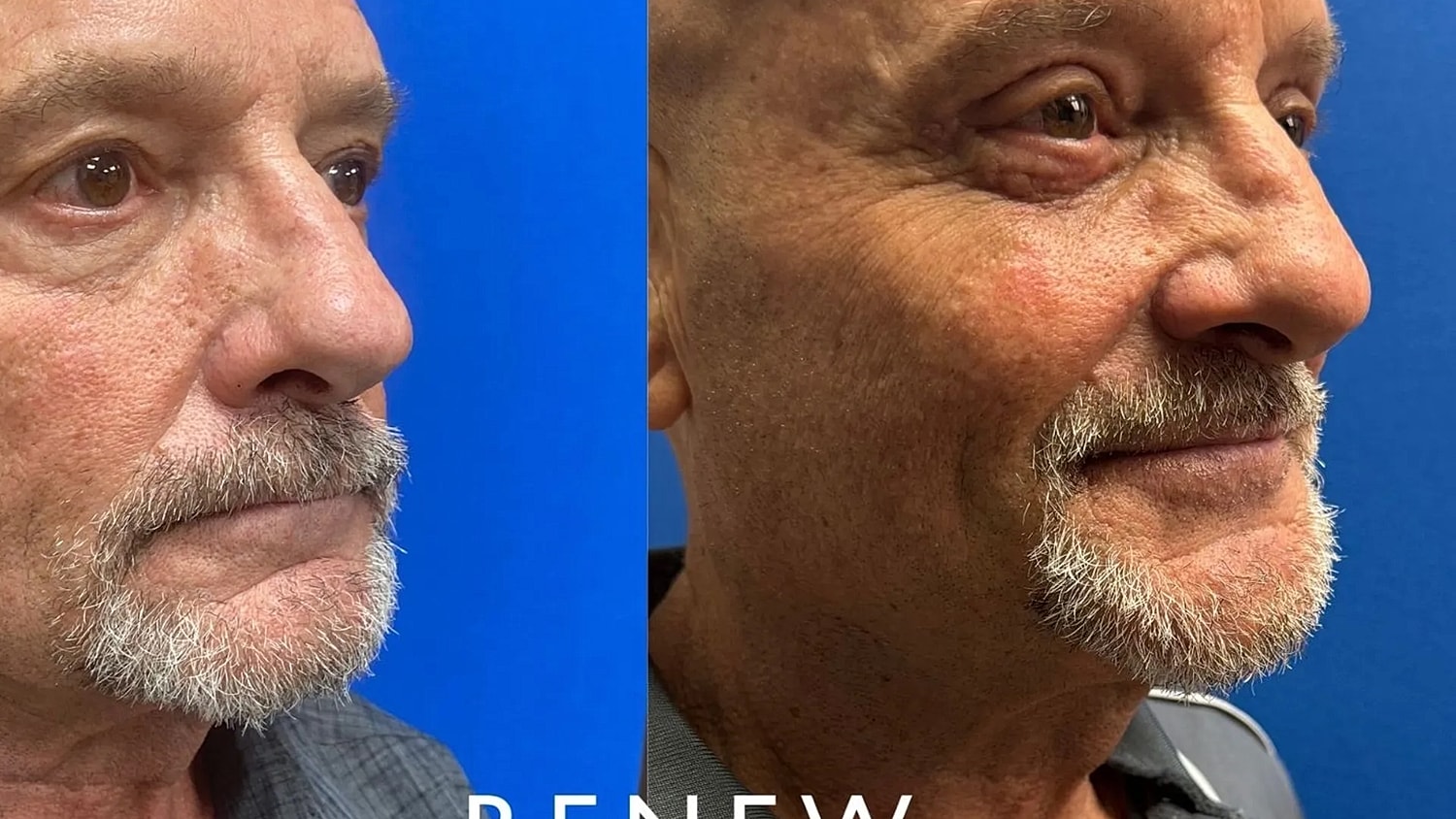 Before and after facial rejuvenation results.