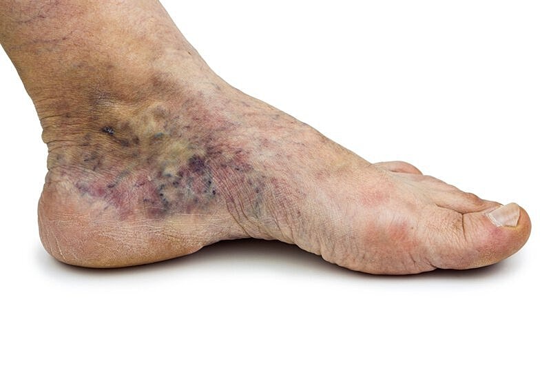 Jordan Page, founder of FunCheaporFree.com, had excruciatingly painful veins in her foot.