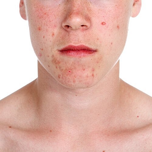 Acne can impact self-confidence as well as happiness.