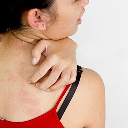 Botox injections may help ease the effects of psoriasis.