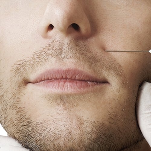 Here are a few reasons to try fat injection.