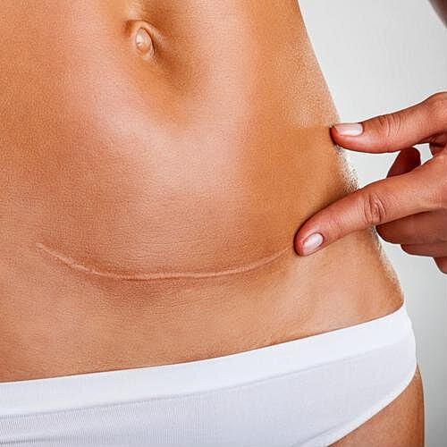 How to reduce the appearance of new scars