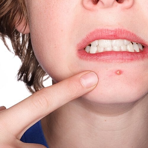 Laser resurfacing is a top way to treat acne and related scarring.