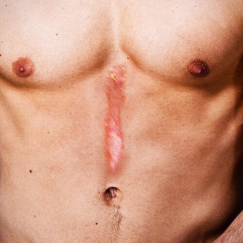 Treating a scar may be possible. A doctor can recommend treatment options.