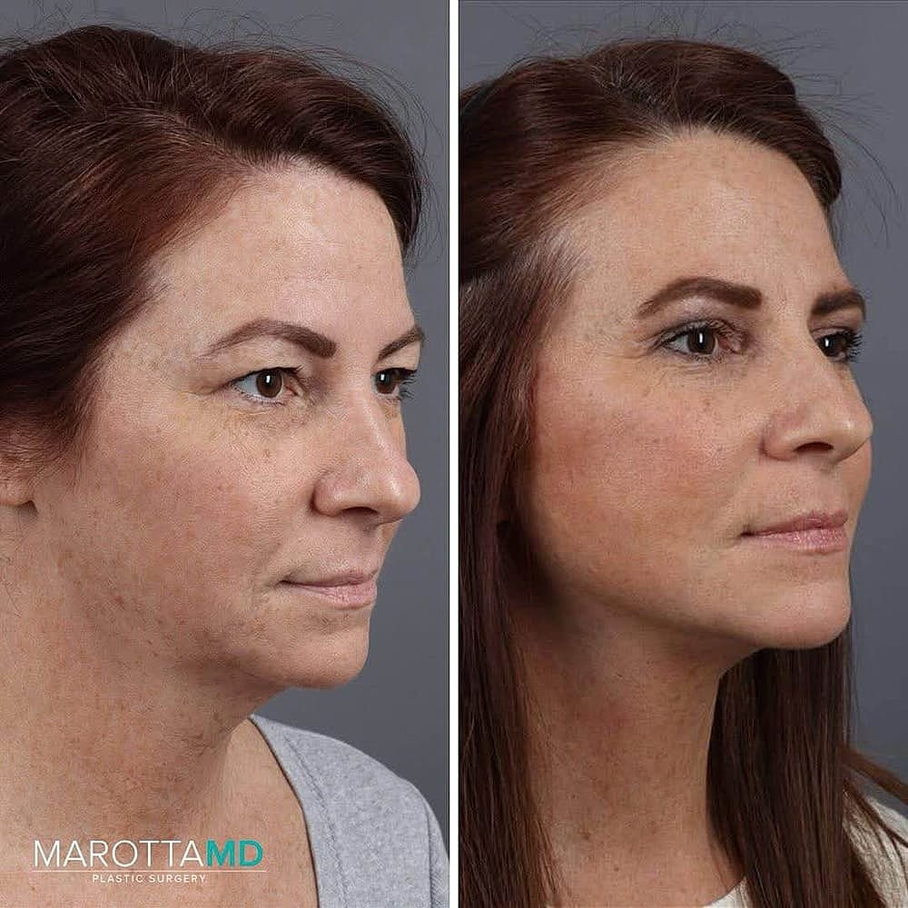 Why More Patients Are Choosing Deep Plane Neck Contouring in Their 40s and 50s