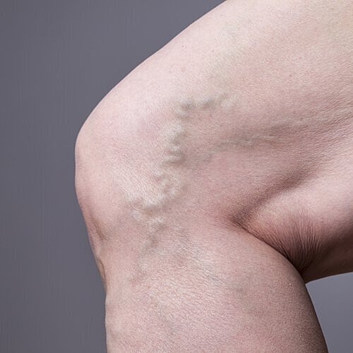 Long Island spider vein treatment
