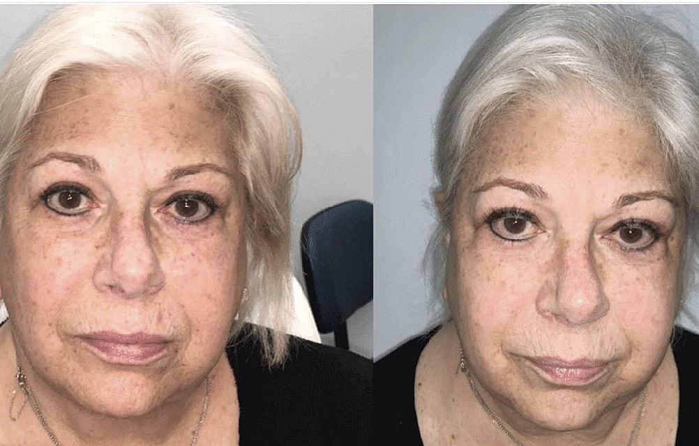 3 Reasons Why Now is the Perfect Time for a Chemical Peel or IPL Treatment - Image 2