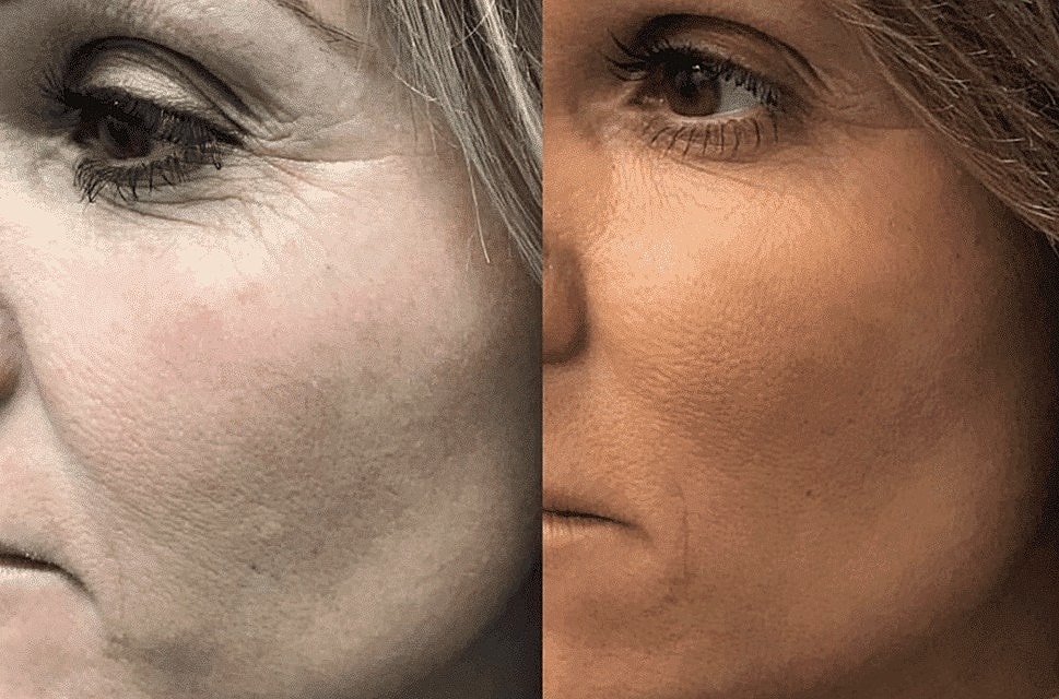 3 Reasons Why Now is the Perfect Time for a Chemical Peel or IPL Treatment