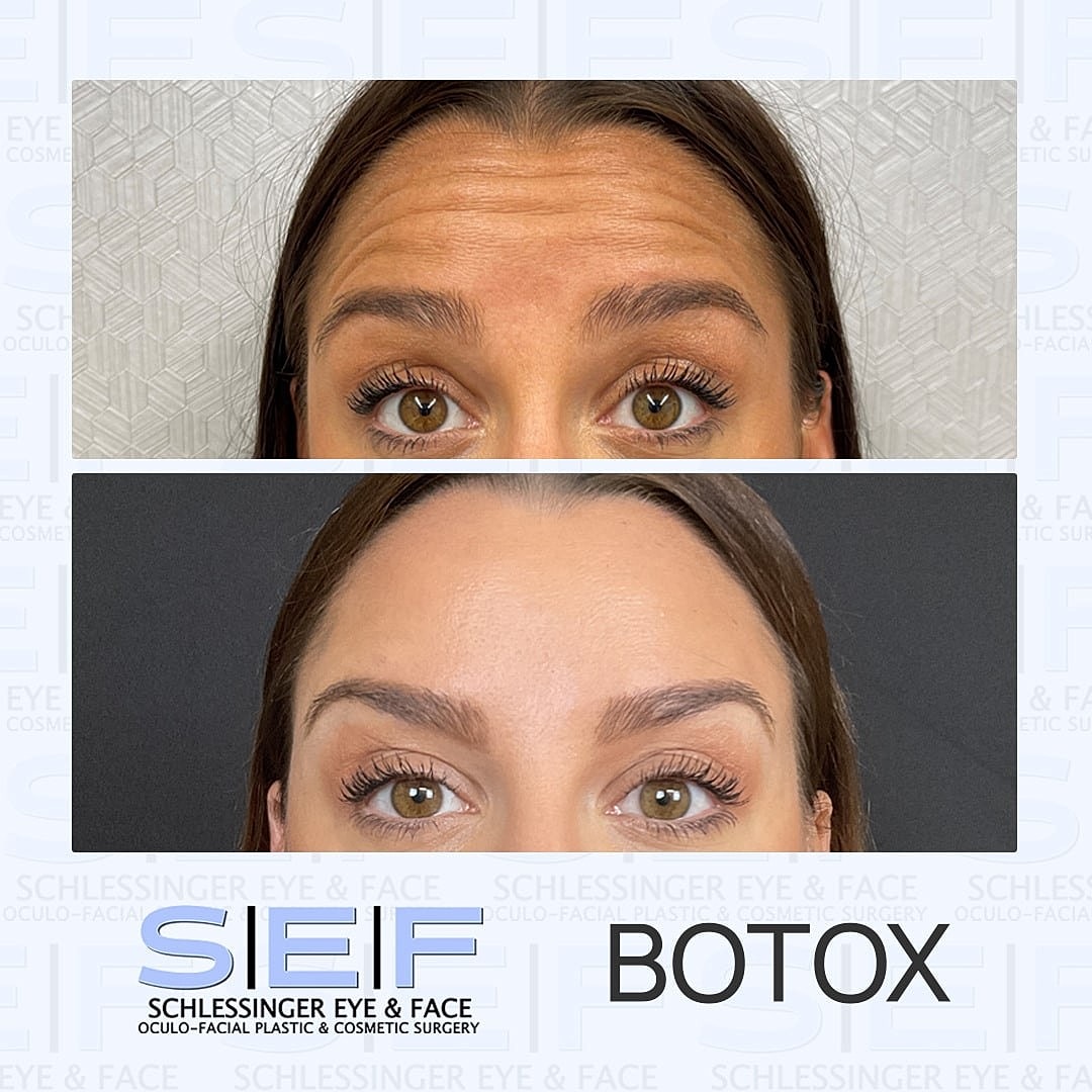 5 Myths About Botox Debunked
