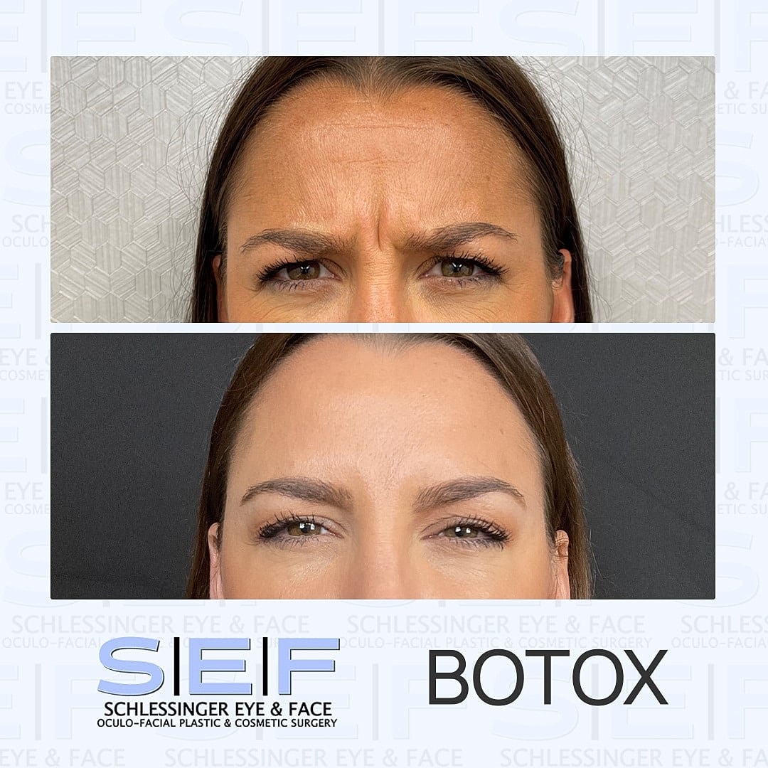 5 Myths About Botox Debunked - Image 2