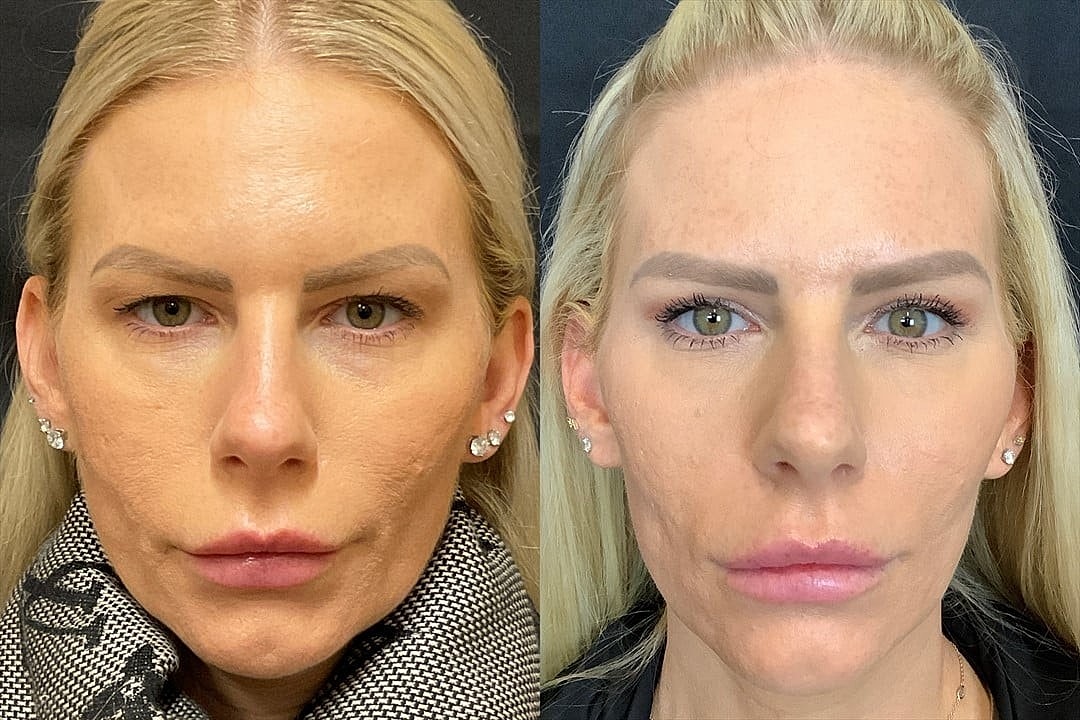 5 Signs That You Should Consider a Browlift - Image 3
