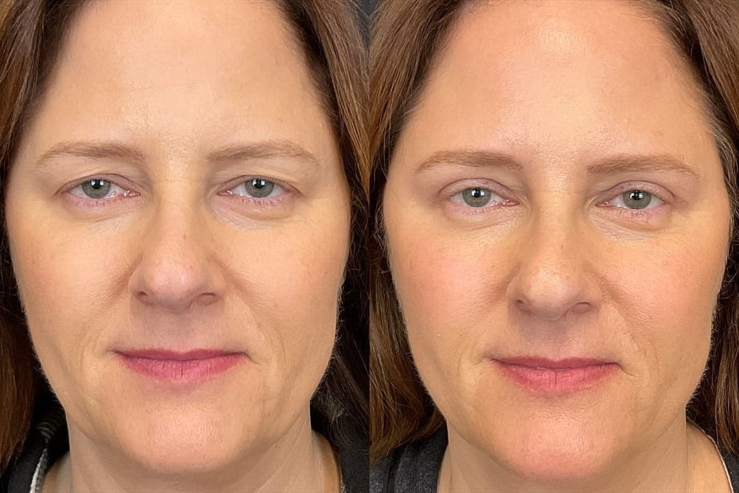 5 Signs That You Should Consider a Browlift - Image 2