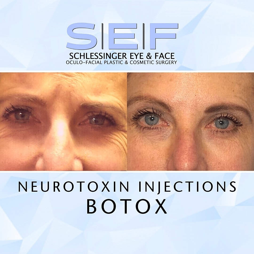 7 Ways Botox Can Improve Your Look - Image 3