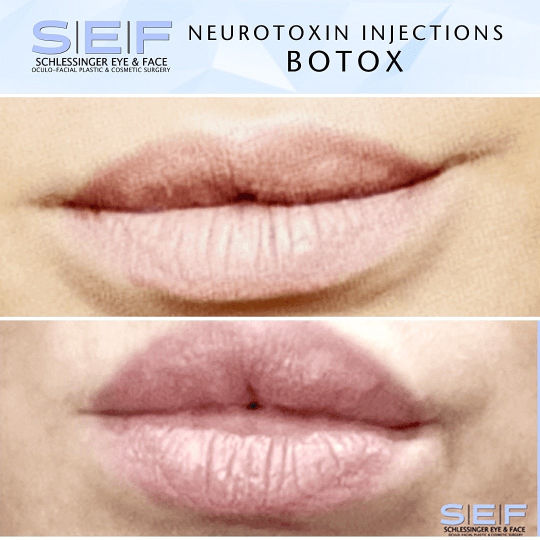 7 Ways Botox Can Improve Your Look - Image 5
