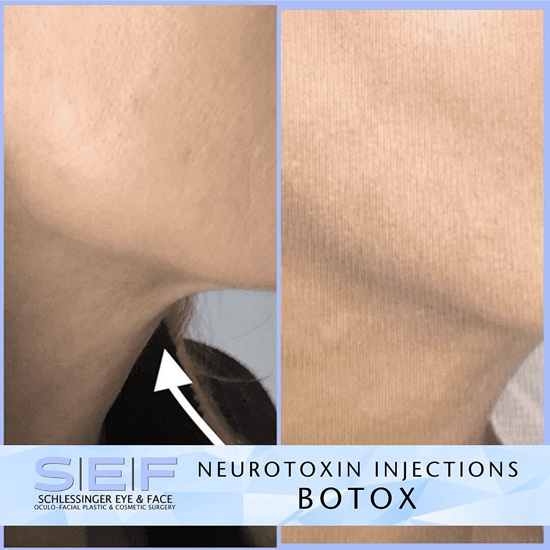 7 Ways Botox Can Improve Your Look - Image 4