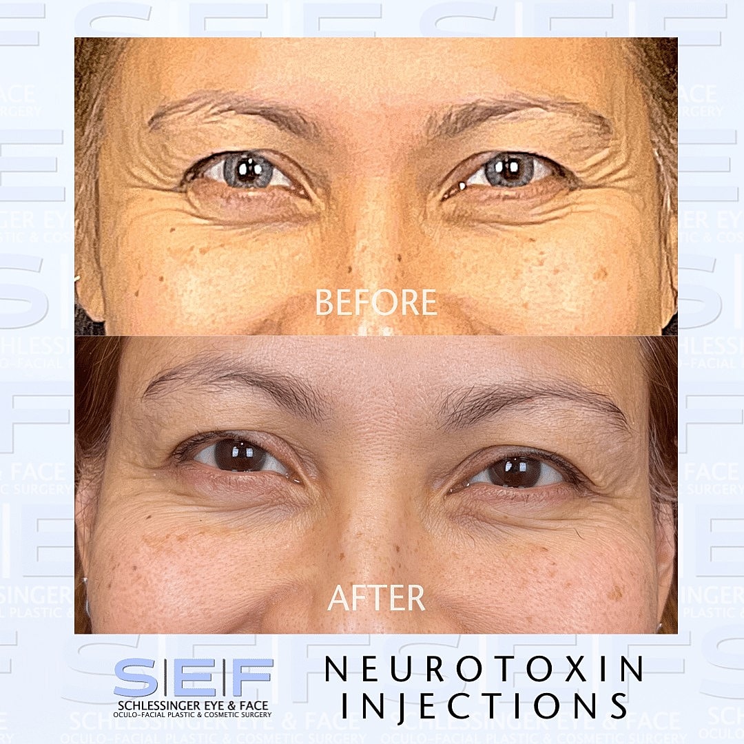 7 Ways Botox Can Improve Your Look - Image 2