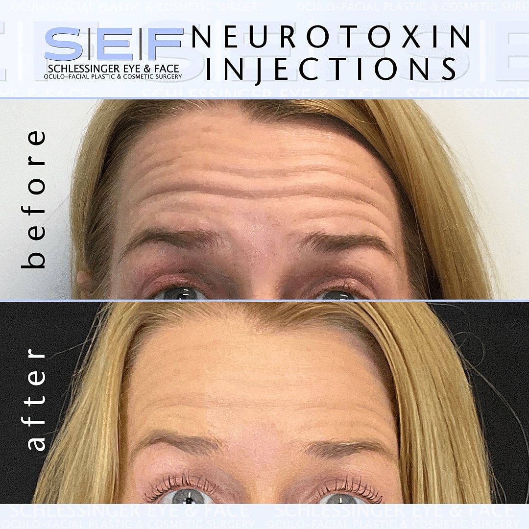 7 Ways Botox Can Improve Your Look