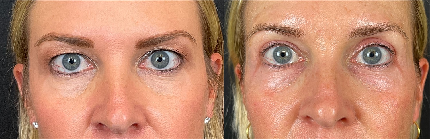 Benefits of a Blepharoplasty for Hooded Eyes - Image 3