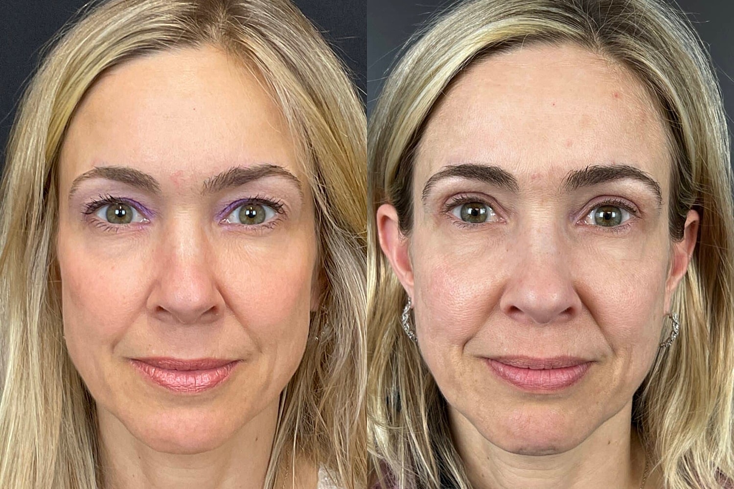 Benefits of a Blepharoplasty for Hooded Eyes - Image 2