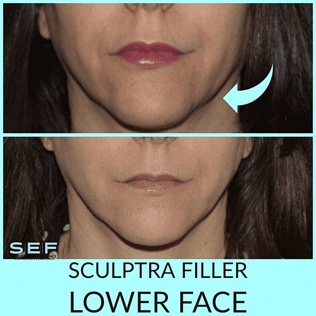 Can You Get a Chiseled Jawline With Injectables? - Image 2