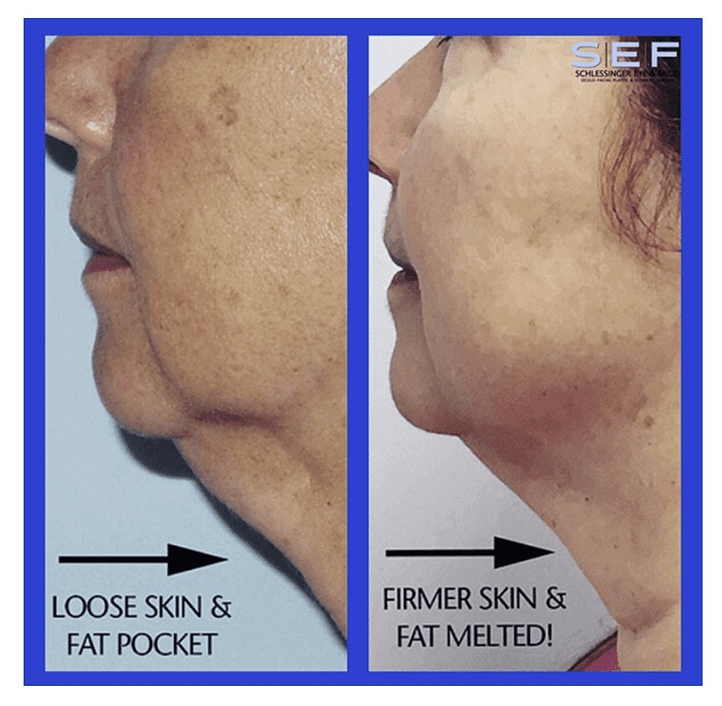 Conquer Turkey Neck with Kybella and Facetite this Season - Image 2