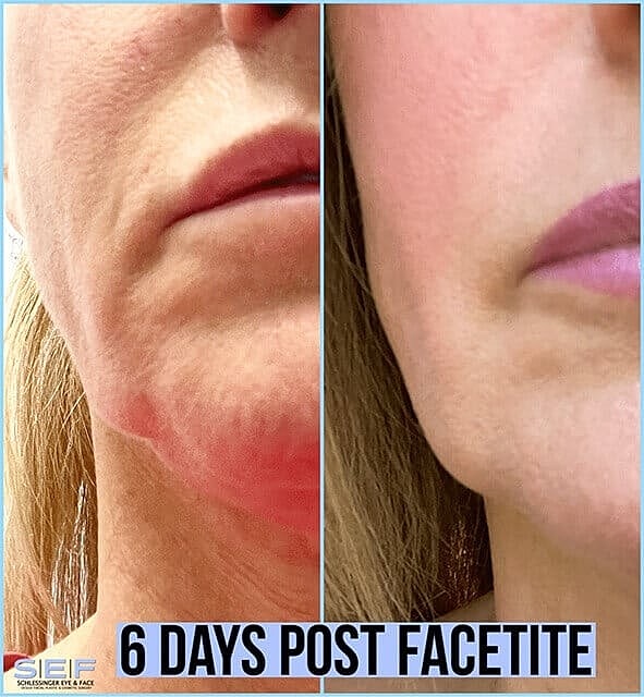Facetite Face-Lift: Look Years Younger Without Going Under the Knife - Image 3