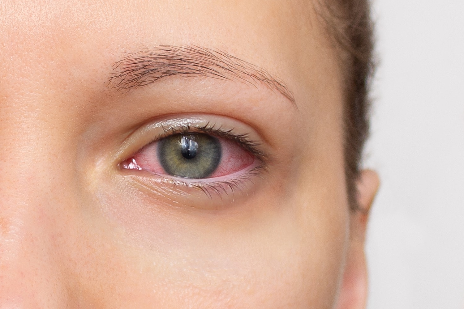 How is Dry Eye Treated?