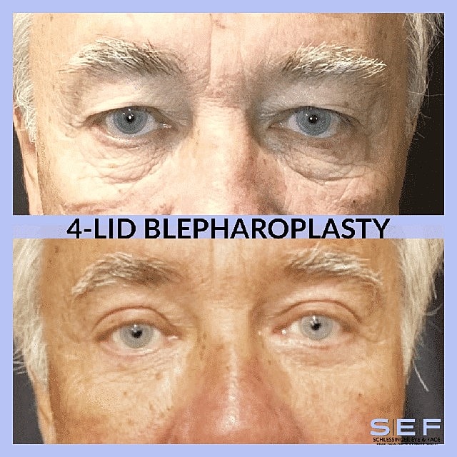 How Long is the Recovery for Eyelid Surgery? - Image 4