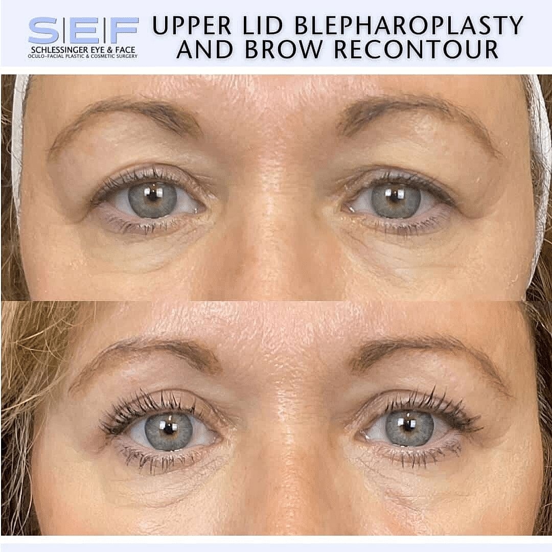 How Long is the Recovery for Eyelid Surgery? - Image 2