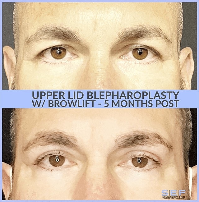 How Long is the Recovery for Eyelid Surgery? - Image 3