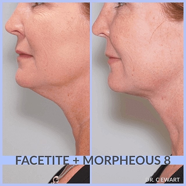 How Morpheus and Facetite Can Rejuvenate Your Neck and Face