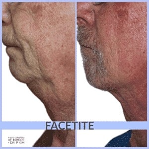 How Morpheus and Facetite Can Rejuvenate Your Neck and Face - Image 3