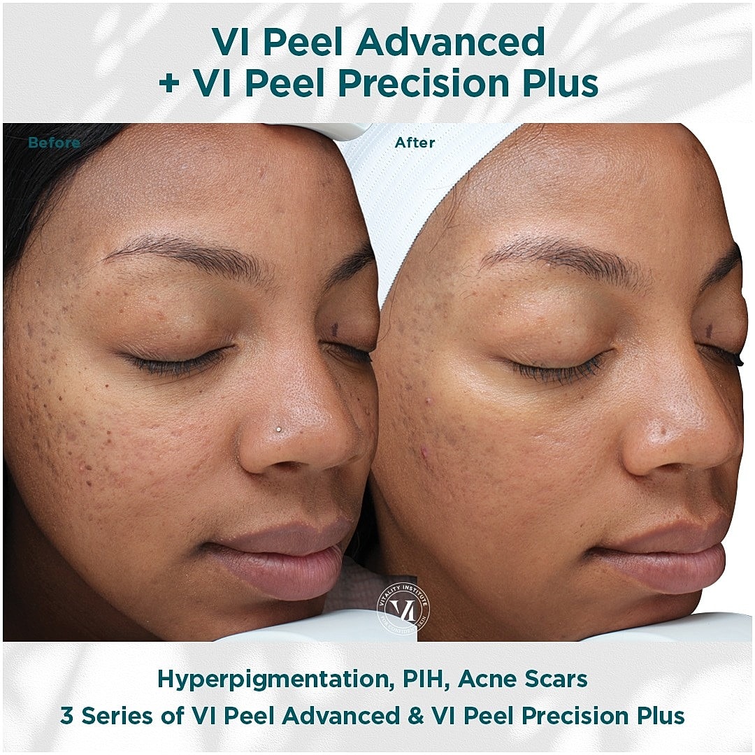 How VI Peels Give You Gorgeous, Youthful Skin - Image 4