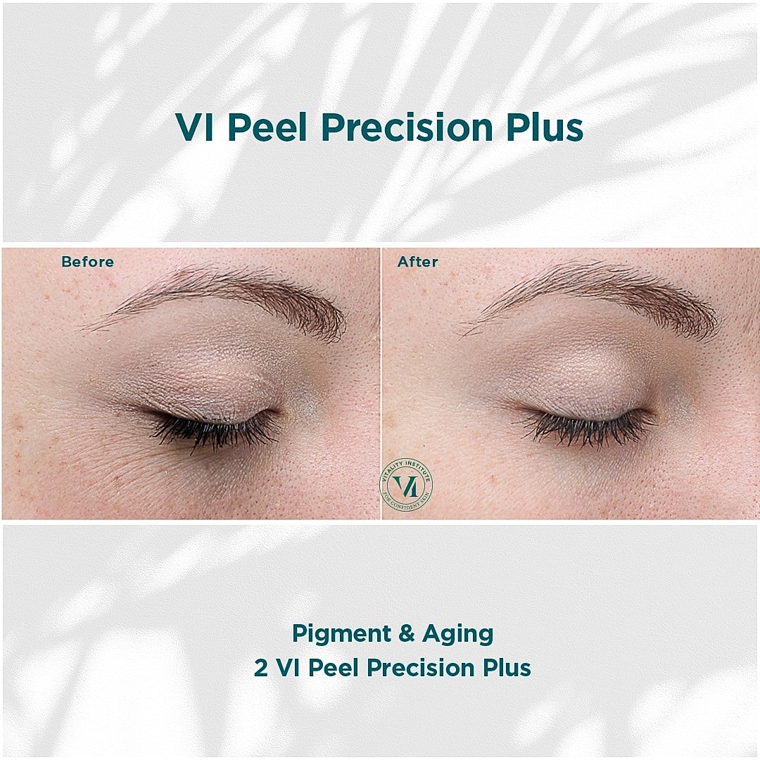 How VI Peels Give You Gorgeous, Youthful Skin - Image 6