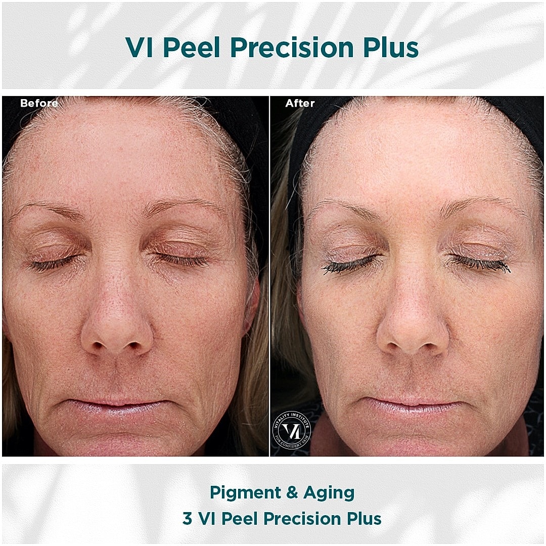 How VI Peels Give You Gorgeous, Youthful Skin - Image 7