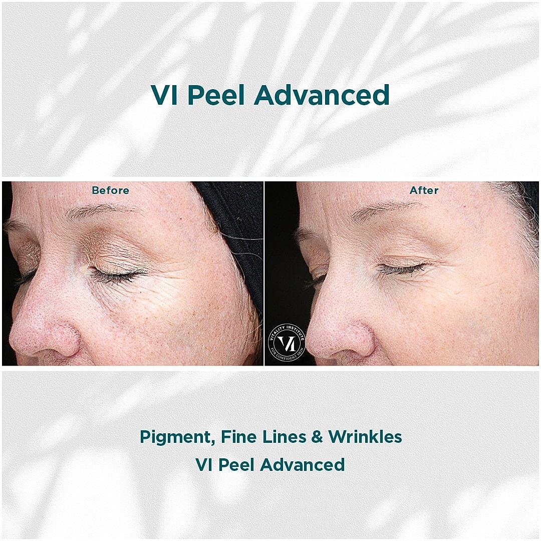 How VI Peels Give You Gorgeous, Youthful Skin - Image 8