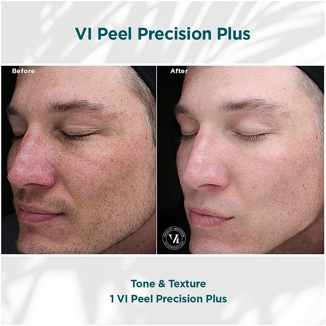 How VI Peels Give You Gorgeous, Youthful Skin - Image 5