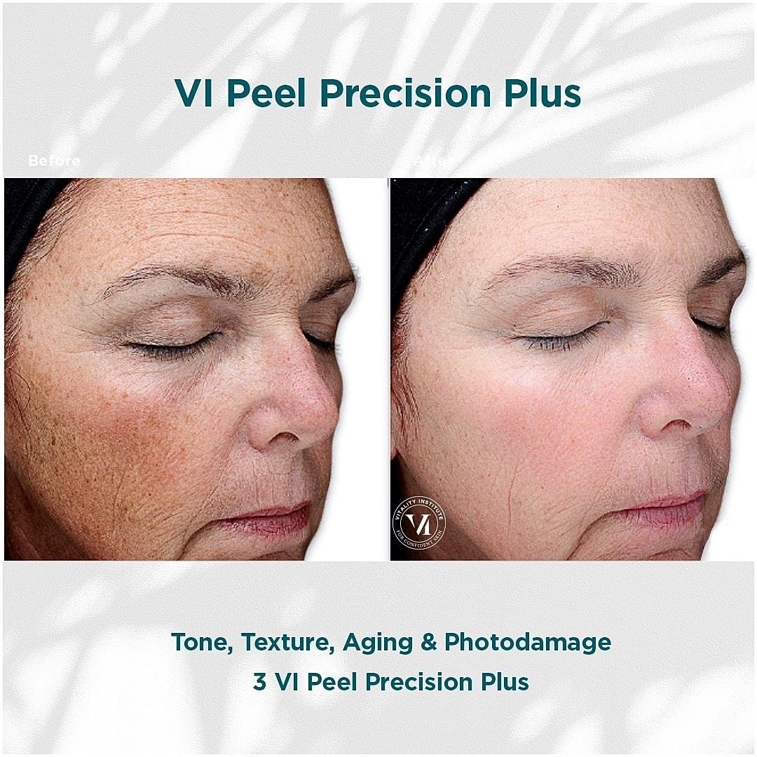 How VI Peels Give You Gorgeous, Youthful Skin - Image 3