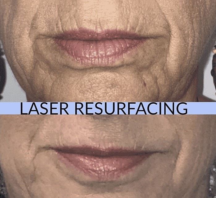 Learn About Advanced Laser & RF Treatments for Skin Rejuvenation - Image 2
