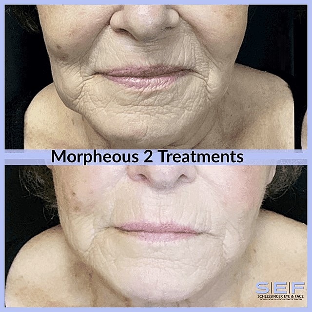 Target Deeper Layers of the Skin with Morpheus8 Microneedling - Image 2