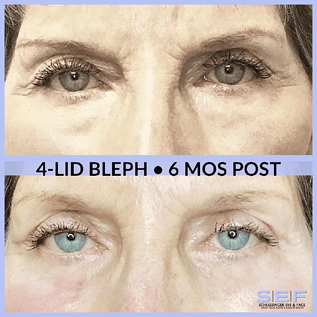 The Top 5 Benefits of Eyelid Surgery You Didn’t Know - Image 2