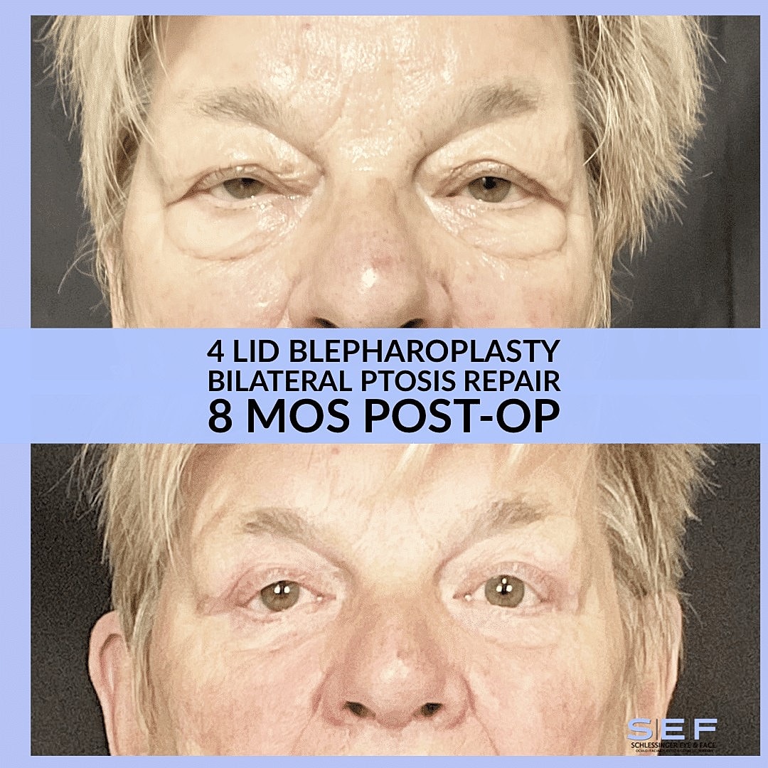 The Top 5 Benefits of Eyelid Surgery You Didn’t Know - Image 3