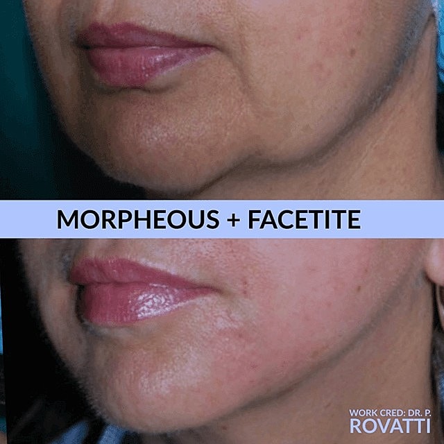 Trends in Cosmetic Facial Surgery - Image 2