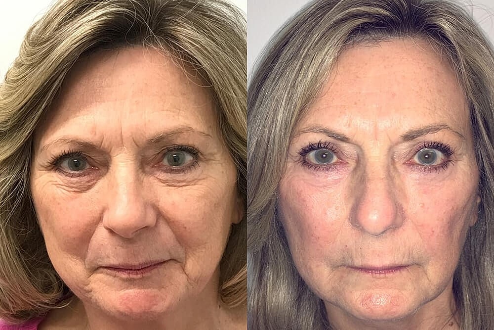 Turn back time with a non-surgical facelift