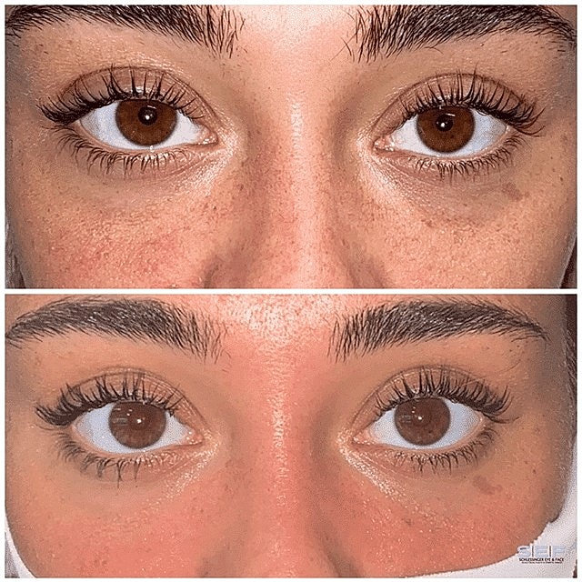 Under Eye Fillers: A Non-Surgical Option for Eye Bag Reduction - Image 2